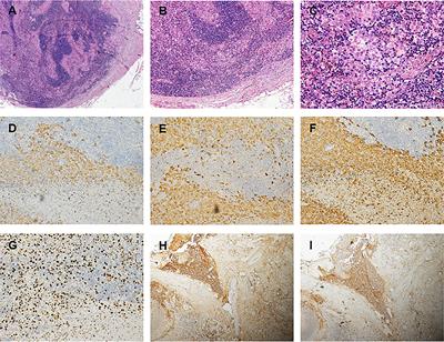 Multi-System Langerhans Cell Histiocytosis as a Mimic of IgG4-Related Disease: A Case Report and Literature Review